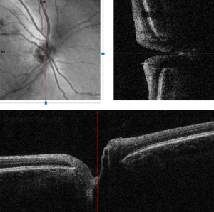 augenarzt biel bienne augenzentrum vernissage oct macula ipl laser katarakt chirurgie