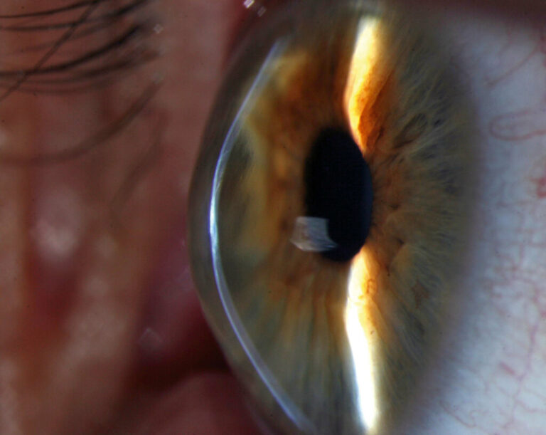 Augenarzt Biel-Bienne Augenzentrum Vernissage OCT Macula Makula IPL Laser Katarakt Chirurgie LASIK PRK LIKE Augenlaser Lidchirurgie Keratokonus