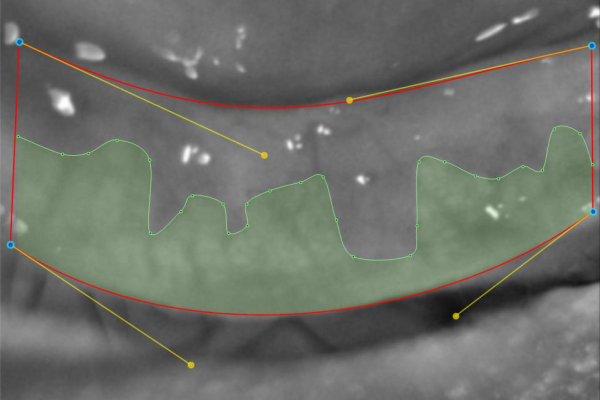 Meibografie des Unterlids mit Darstellung der Meibom-Drüsen bei trockenen Augen